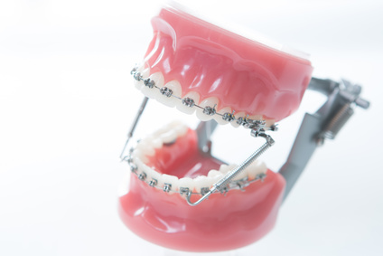 Gli apparecchi ortodontici sono la soluzione per ottenere un sorriso perfetto: sperimenta la differenza con i nostri servizi di ortodonzia di alta qualità