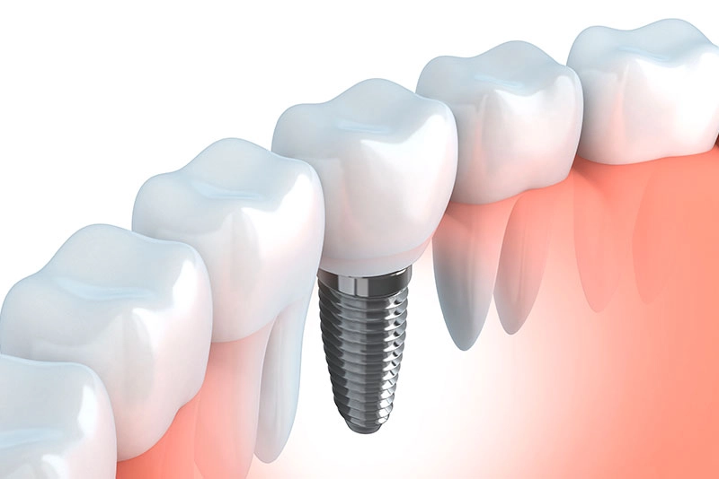 Ripristina la salute e la bellezza del tuo sorriso con i nostri servizi odontoiatrici di implantologia dentale personalizzati.