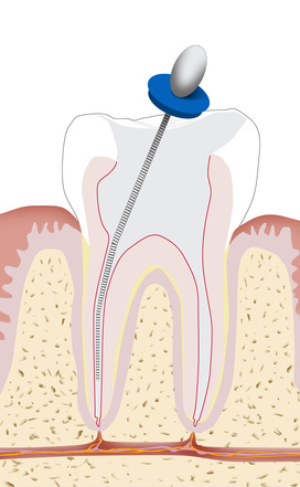 Risolviamo il tuo dolore al dente con la nostra esperienza in endodonzia. Ti aiuteremo a mantenere il tuo sorriso sano e luminoso!