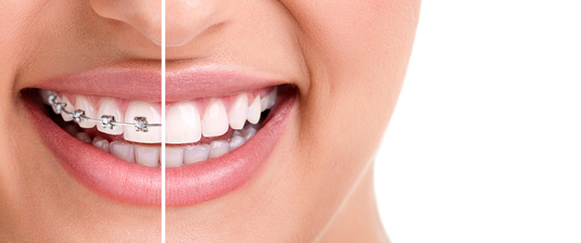 estetica dentale : Le faccette estetiche dentali sono sottilissime lamine in porcellana o ceramica che vengono fissate sulla superficie dei denti mediante colle speciali a forte adesività