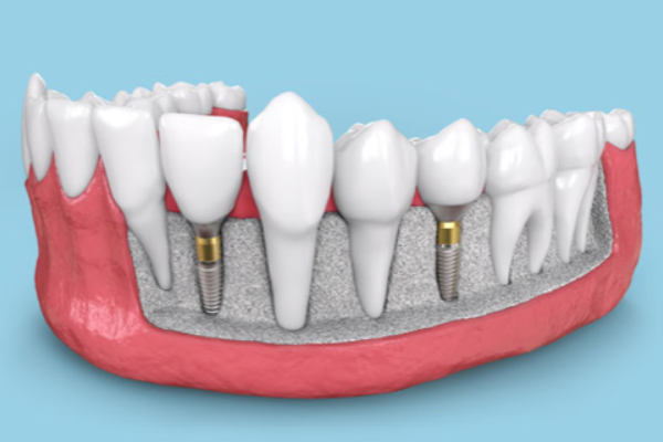 32 cliniche dentali immagini di implantologia dentale. Parte inferiore della mandibola