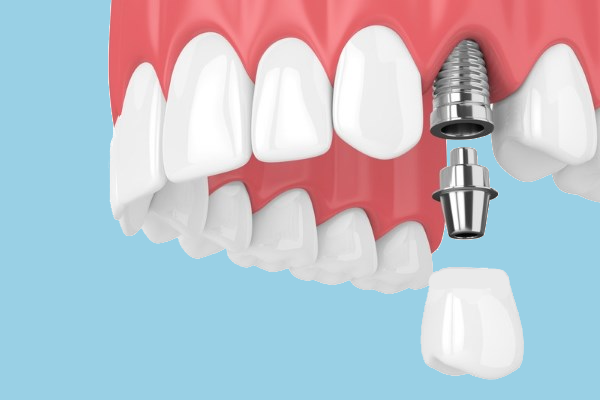 32 cliniche dentali immagini di implantologia dentale. Parte superiore della bocca