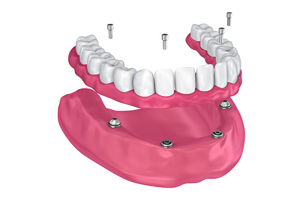 implantologia dentale: la tecnica dell' all on four presso 32 cliniche dentali